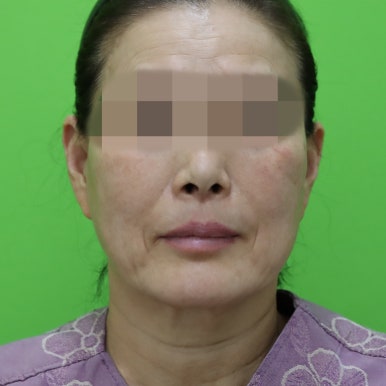안면거상술, 이중턱 근육 묶기 후 회복 기간 관련 이미지 1