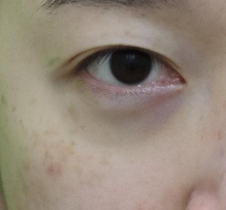 눈밑패임, 이거 모르면 효과 없는 시술에만 돈 씁니다. 관련 이미지 2