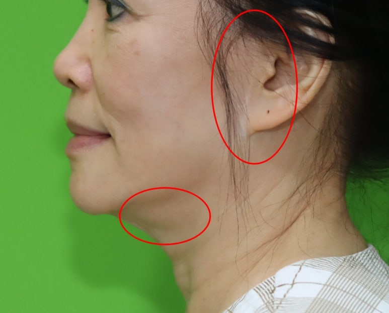 Revision Facelift 3 Months Later, Including Removal of the Existing Scar image 3