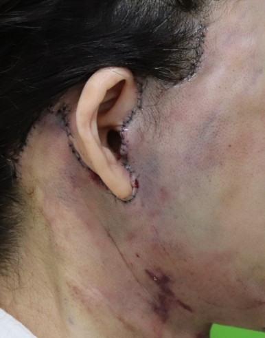 Facelift Scars, the Reason They Look Seamless After 6 Months image 8