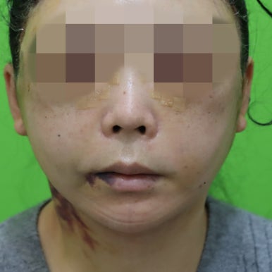 Early Swelling Changes After Facelift (Day 3, 1 Week, 2 Weeks) image 5