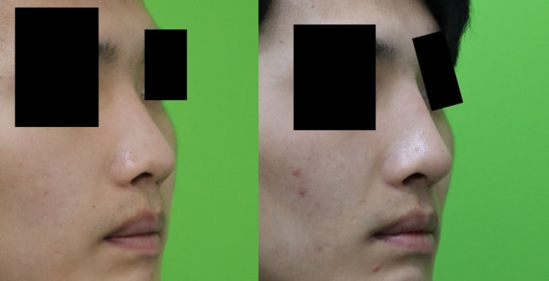 Crooked Nose Surgery: If You Don’t Know This, You’ll Need Revision Surgery Again. image 11