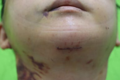 Early Swelling Changes After Facelift (Day 3, 1 Week, 2 Weeks) image 6