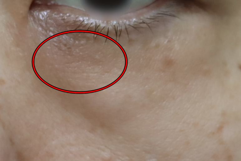 Under-Eye Fat Repositioning vs. Lower Blepharoplasty: Selection Criteria You Should Know image 1