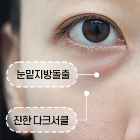 눈밑지방재배치, 수술에 대해 꼭 알아야 할 것 관련 이미지 10
