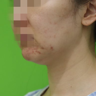 몸은 말랐는데 이중턱살제거가 시급할 때? 관련 이미지 19