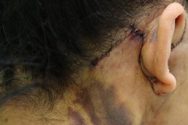 Early Swelling Changes After Facelift (Day 3, 1 Week, 2 Weeks) image 10