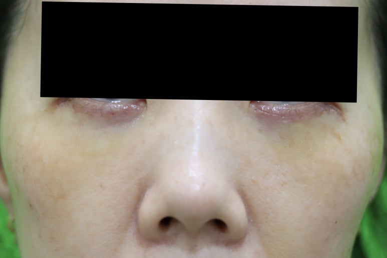 Blepharoplasty Day 1 and Day 7 Swelling and Scar Review image 3