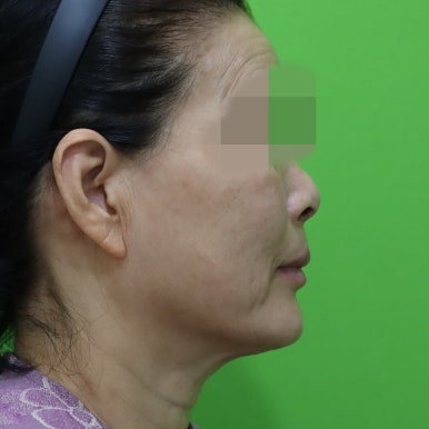 안면거상술, 이중턱 근육 묶기 후 회복 기간 관련 이미지 29