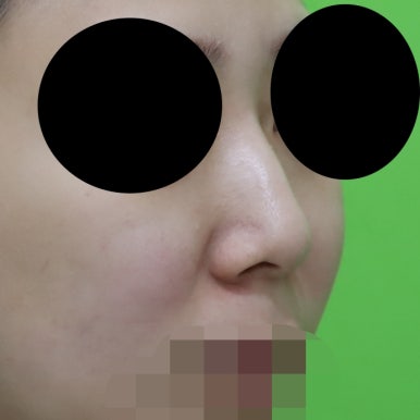 매부리코교정, 코뼈 제거 없이 재배치로 해결 관련 이미지 7