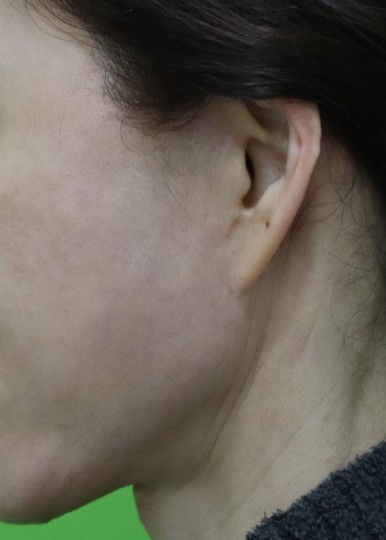 Facelift Scars, the Reason They Look Seamless After 6 Months image 22