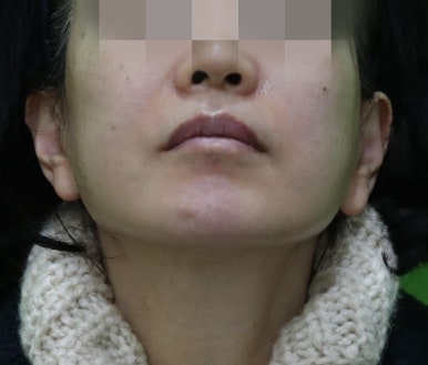 안면거상 재수술, 왜 3년전 수술이 효과가 없었을까? 관련 이미지 16