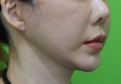 Facelift Results: Can They Be Good Even at a Young Age? image 9