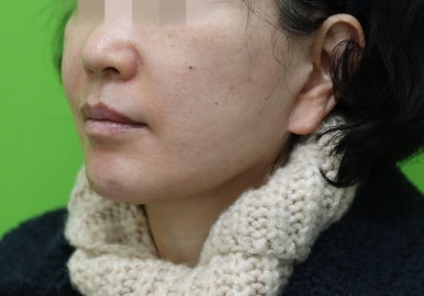 안면거상 재수술, 왜 3년전 수술이 효과가 없었을까? 관련 이미지 22