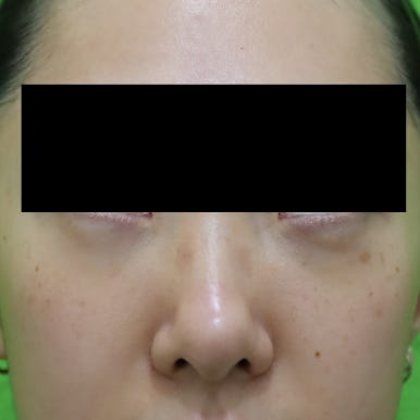 눈밑지, 지방이식 같이 하면 회복이 더 오래 걸리나? 관련 이미지 5