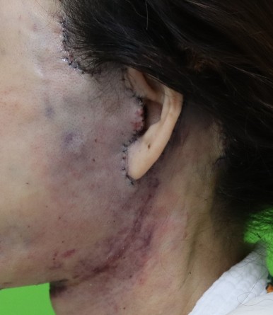 Facelift Scars, the Reason They Look Seamless After 6 Months image 10
