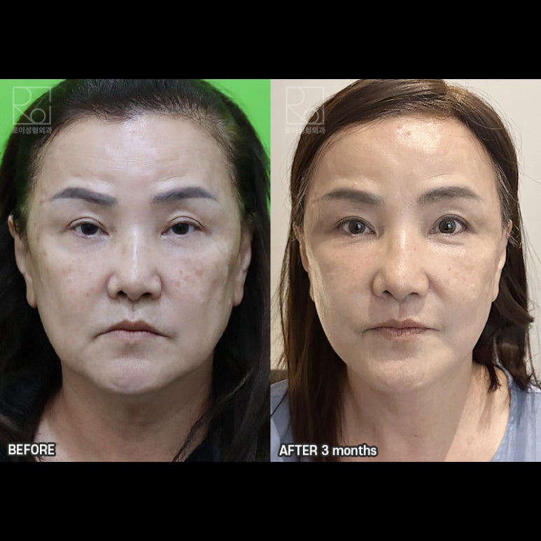 Facelift Review: A Woman in Her Early 60s Looks More Than 10 Years Younger image 6