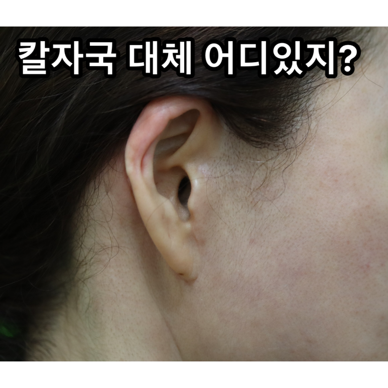 Facelift Scars, the Reason They Look Seamless After 6 Months image 28
