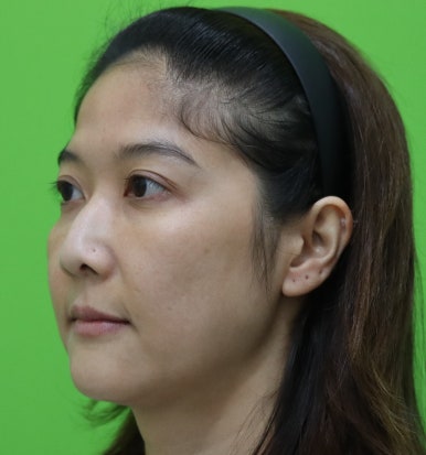 매부리코성형비용, 상담실장이 보면 싫어할 양심 선언 관련 이미지 7