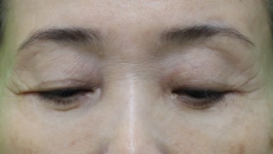 하안검수술흉터, 이 원본 사진에서 잘 보이나요? 관련 이미지 13