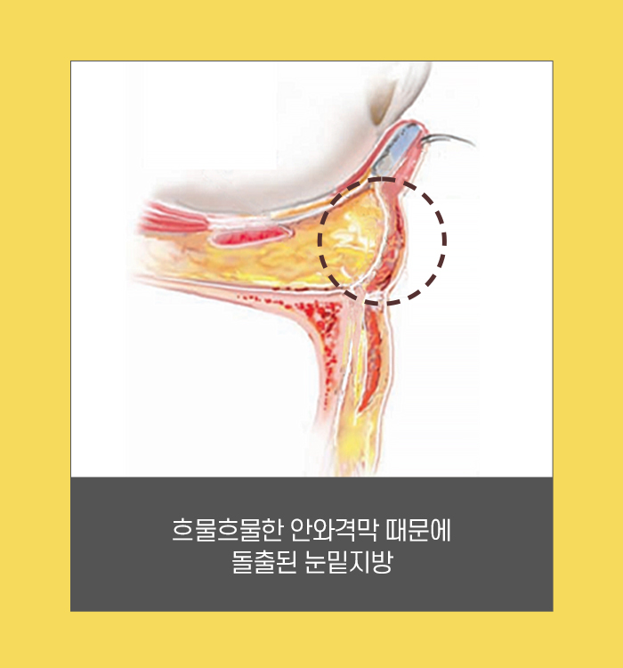 눈밑지방재배치, 수술에 대해 꼭 알아야 할 것 관련 이미지 3