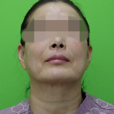 안면거상술, 이중턱 근육 묶기 후 회복 기간 관련 이미지 2