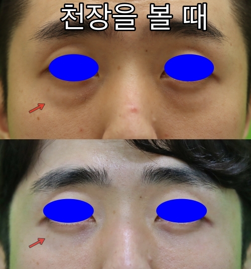 3 Things You Must Know Before Male Under-Eye Fat Repositioning image 5