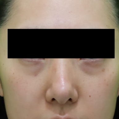 눈밑지, 지방이식 같이 하면 회복이 더 오래 걸리나? 관련 이미지 2