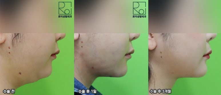 Double Chin Removal: Did You Think Liposuction Alone Would Be Enough? image 5