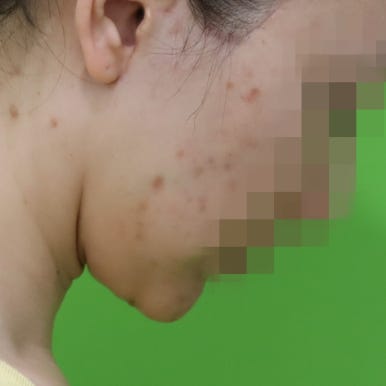 몸은 말랐는데 이중턱살제거가 시급할 때? 관련 이미지 8