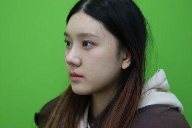 복코성형, 연예인 지망생의 리얼 후기 관련 이미지 9