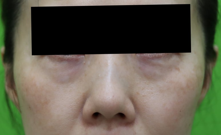 Blepharoplasty Day 1 and Day 7 Swelling and Scar Review image 1
