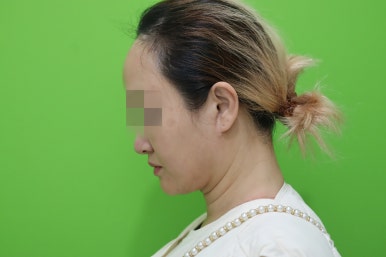 이중턱살제거, 마른 몸에 이중턱만 고민이라면? 관련 이미지 12