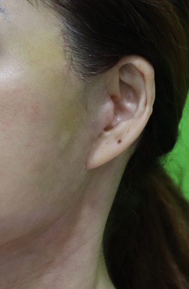 Facelift Scars, the Reason They Look Seamless After 6 Months image 13