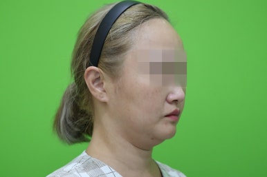 이중턱살제거, 마른 몸에 이중턱만 고민이라면? 관련 이미지 13