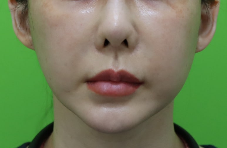 Facelift Results: Can They Be Good Even at a Young Age? image 10
