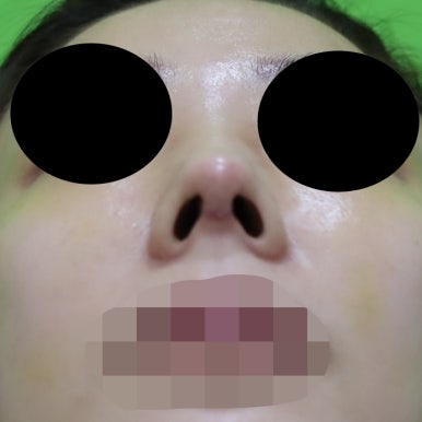 매부리코교정, 코뼈 제거 없이 재배치로 해결 관련 이미지 16