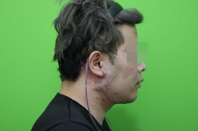 Double Chin Muscle Tying Swelling, Day 1 Appearance image 16