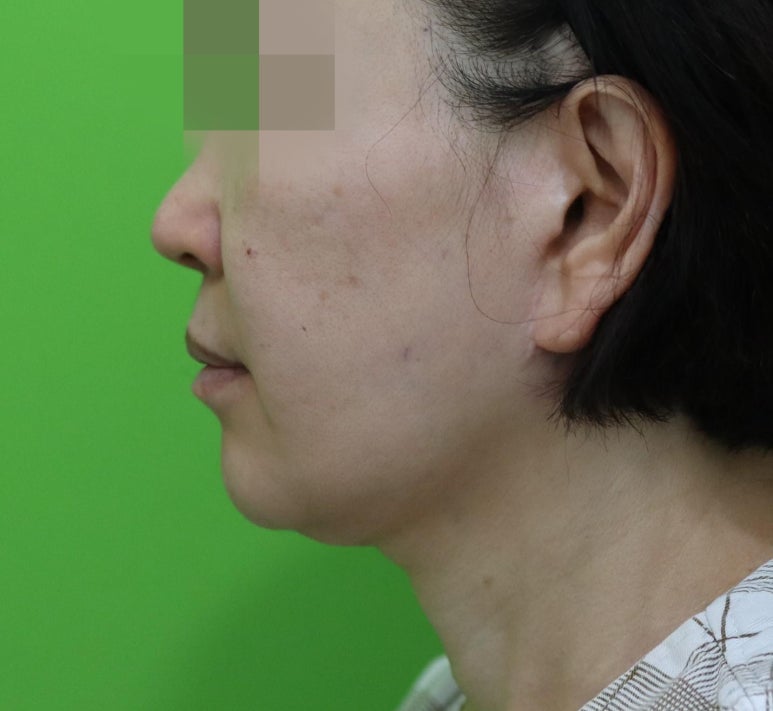 안면거상 재수술, 왜 3년전 수술이 효과가 없었을까? 관련 이미지 2
