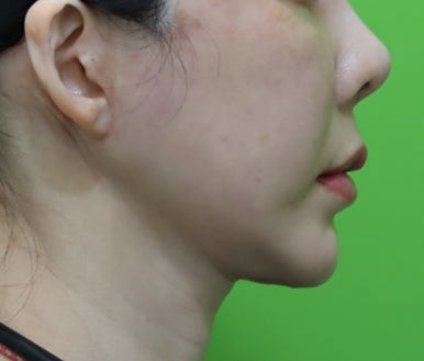 Facelift Results: Can They Be Good Even at a Young Age? image 8