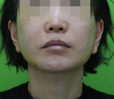 안면거상 재수술, 왜 3년전 수술이 효과가 없었을까? 관련 이미지 8