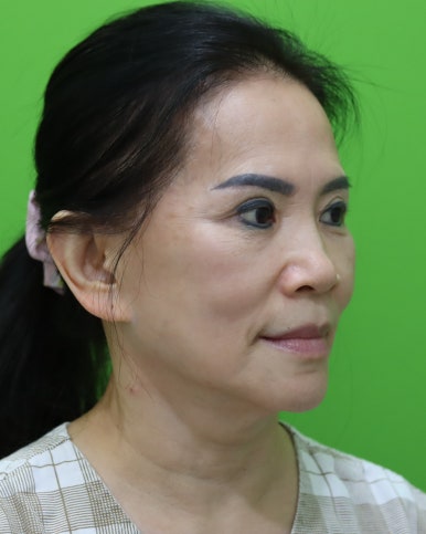 Revision Facelift 3 Months Later, Including Removal of the Existing Scar image 9