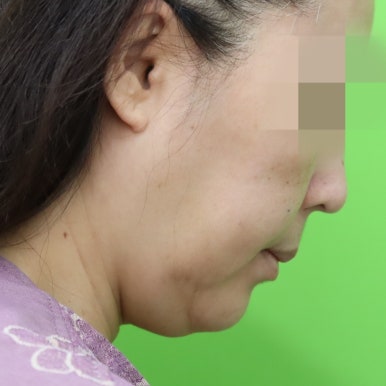 Early Swelling Changes After Facelift (Day 3, 1 Week, 2 Weeks) image 4