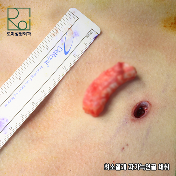 Crooked Nose Surgery: If You Don’t Know This, You’ll Need Revision Surgery Again. image 6