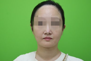 이중턱살제거, 마른 몸에 이중턱만 고민이라면? 관련 이미지 6