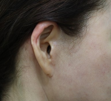 Facelift Scars, the Reason They Look Seamless After 6 Months image 19