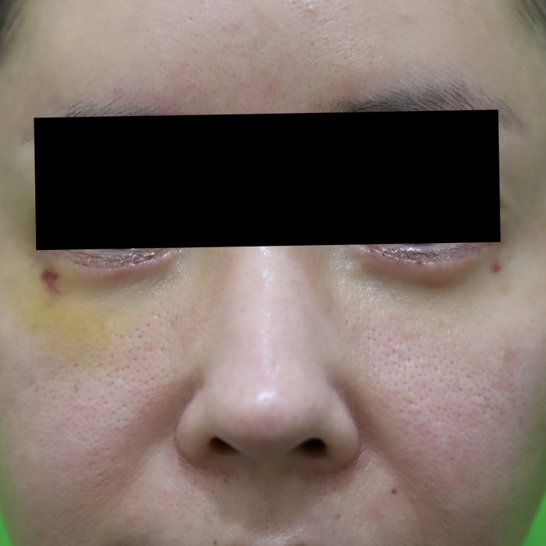 부자연스러운 애교살 지방이식 제거, 수술 후기 관련 이미지 3
