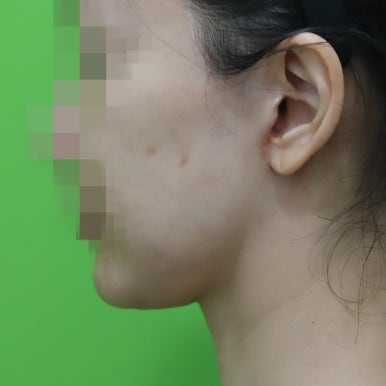 몸은 말랐는데 이중턱살제거가 시급할 때? 관련 이미지 22