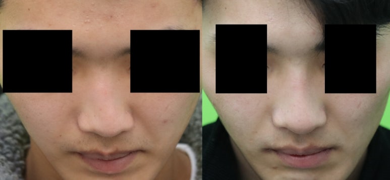 Crooked Nose Surgery: If You Don’t Know This, You’ll Need Revision Surgery Again. image 9