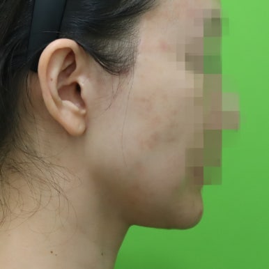 몸은 말랐는데 이중턱살제거가 시급할 때? 관련 이미지 16